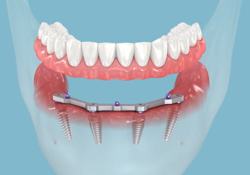 Who is a Good Candidate for the All on 4 Procedure?