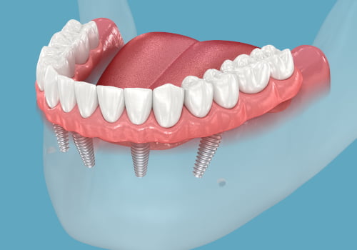How Much Do All-on-4 Implants Cost in Mississauga?