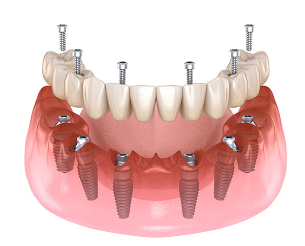 Illustration of full-arch implant dentistry showing an All-on-4 implant-supported prosthesis with four dental implants in the lower jaw