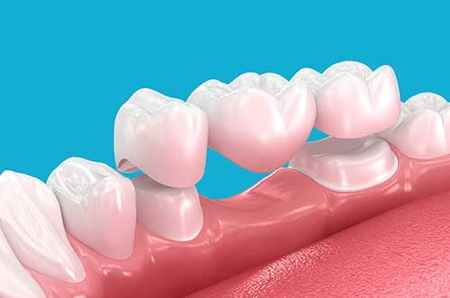 3D illustration of a dental bridge demonstrating materials used to restore missing teeth and support oral function.