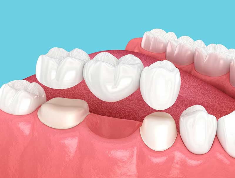 3D illustration of a dental bridge showing an artificial tooth supported by adjacent natural teeth.
