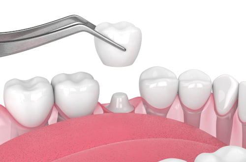 Dental crown restoration placed over a prepared tooth during prosthodontic treatment.