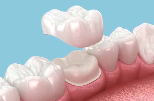 dental crowns cost Mississauga consultation treatment plan pricing