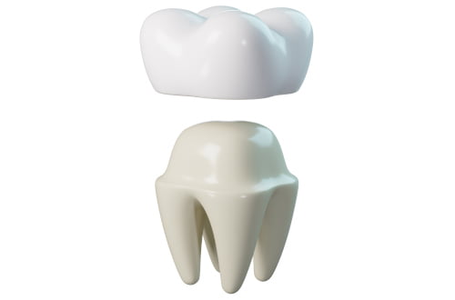 dental crowns, durability, long lasting restorations, oral care