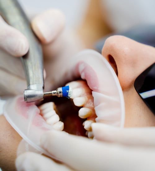 A dental hygienist performing scaling to remove plaque and tartar during a teeth cleaning appointment in Mississauga.