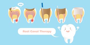 8 Important Reasons Why You Should Have That Root Canal Done Now