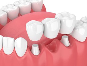What Are the Advantages Of Dental Bridges? | Skymark Smile Centre Blog