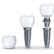 5 Key Questions People Ask About All on Four Dental Implants