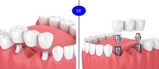 Choosing Between Dental Implants and Bridges: A Comprehensive Guide to Better Oral Health