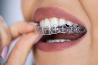 Invisalign Costs in Canada: Key Factors & Long-Term Benefits