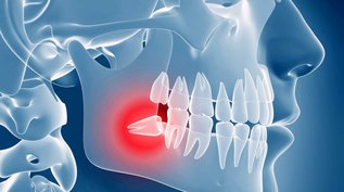 Understanding the When and Why of Wisdom Teeth Removal