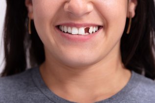 Surgical Solutions for Replacing Missing Teeth: Restore Your Smile and Confidence