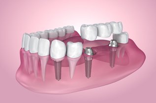 What Are Teeth In A Day Implants? | Skymark Smile Centre Blog