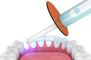 Aesthetic Dental Bonding in Canada: Cost, Benefits & Smile Fixes