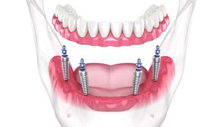 All-on-4 Dental Implants in Mississauga: Cost, Procedure & Recovery | Skymark Smile Centre