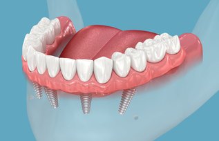 5 Key Questions People Ask About All on Four Dental Implants