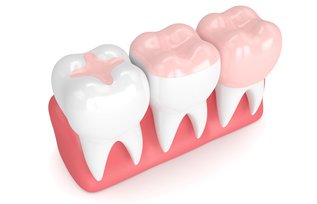 Dental Crown vs Filling: Which Tooth Restoration Is Right for You?