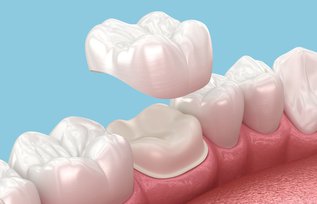 Dental Crowns in Ontario: Types, Cost & Procedure | Skymark Smile Centre