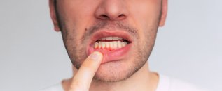 Frequently Asked Questions About Gingivitis: Symptoms, Treatment, and Prevention