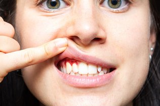 Why Do My Gums Bleed? Causes, Solutions, and Prevention Tips