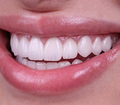Does Dental Insurance Cover Porcelain Veneers in Canada? Costs & Coverage