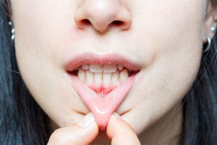 Receding Gums: Causes, Treatment & Prevention | Skymark Smile Centre