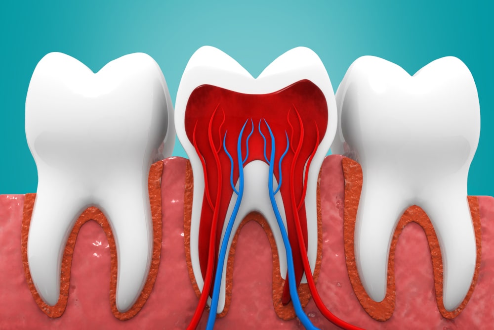 Root Canal