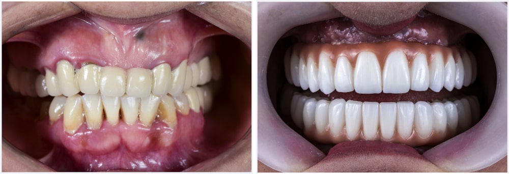Full mouth rehabilitation showing crowns and veneers after All-on-Four dental implant treatment Full Mouth Rehabilitation with All-on-Four Dental Implants