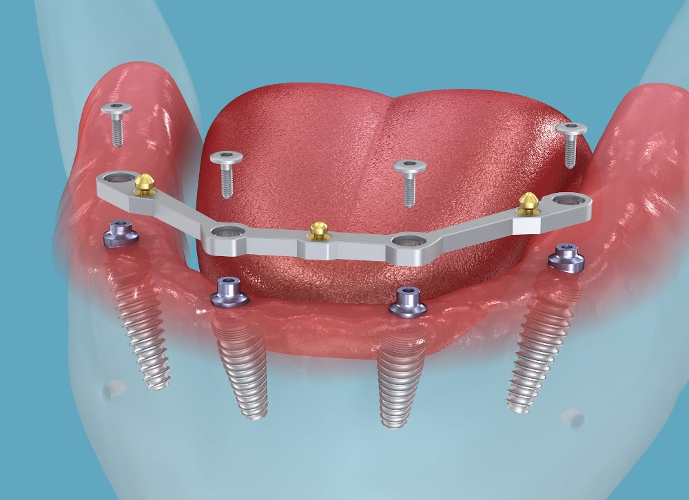 Dentist demonstrating jaw model with four implants to explain All-on-Four treatment candidacy All-on-Four Implant Consultation and Candidacy Evaluation