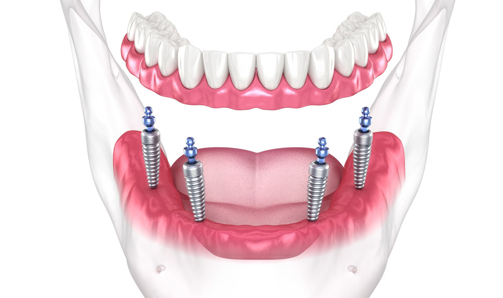 Removable mandibular prosthesis illustrating the All-on-Four dental implant system All-on-Four Implant System Demonstration – Mandibular Prosthesis