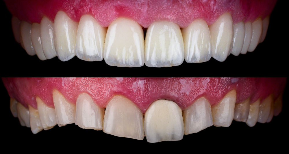 Custom Fit for a Natural Look with Porcelain Veneers Close-up of ceramic crowns and porcelain veneers, illustrating the precise, custom-fit nature of veneers that enhance the natural appearance of your teeth.