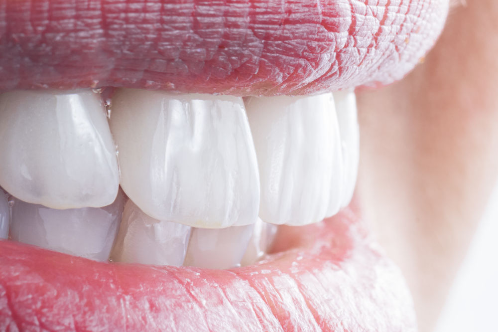Stain Resistance: The Benefit of Porcelain Veneers Image of ceramic crowns and veneers, highlighting the stain-resistant properties of porcelain veneers that help maintain a bright, white smile over time.