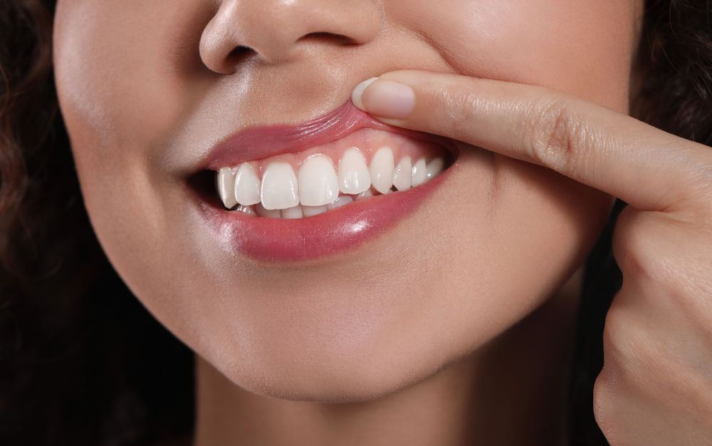 Healthy Teeth and Gums for Successful Dental Bonding Close-up of healthy teeth and gums, illustrating ideal conditions for aesthetic dental bonding treatment.