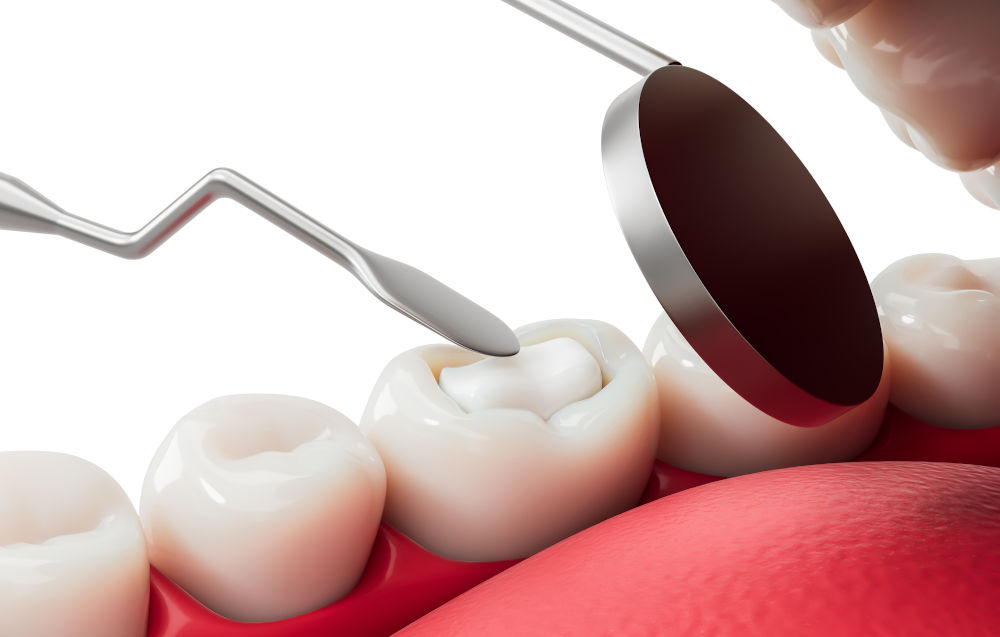 Dental filling procedure concept showing a tooth being restored after decay removal, illustrating when fillings are used for small to moderate cavities.