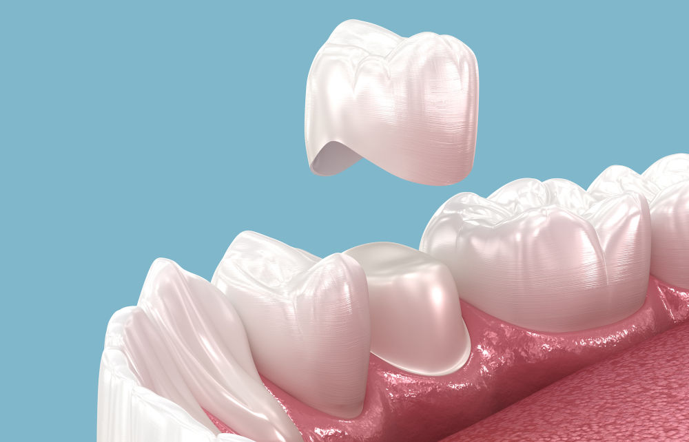 3D illustration of a crown being seated over a prepared tooth, representing how crowns protect teeth with extensive decay, cracks, or large restorations.