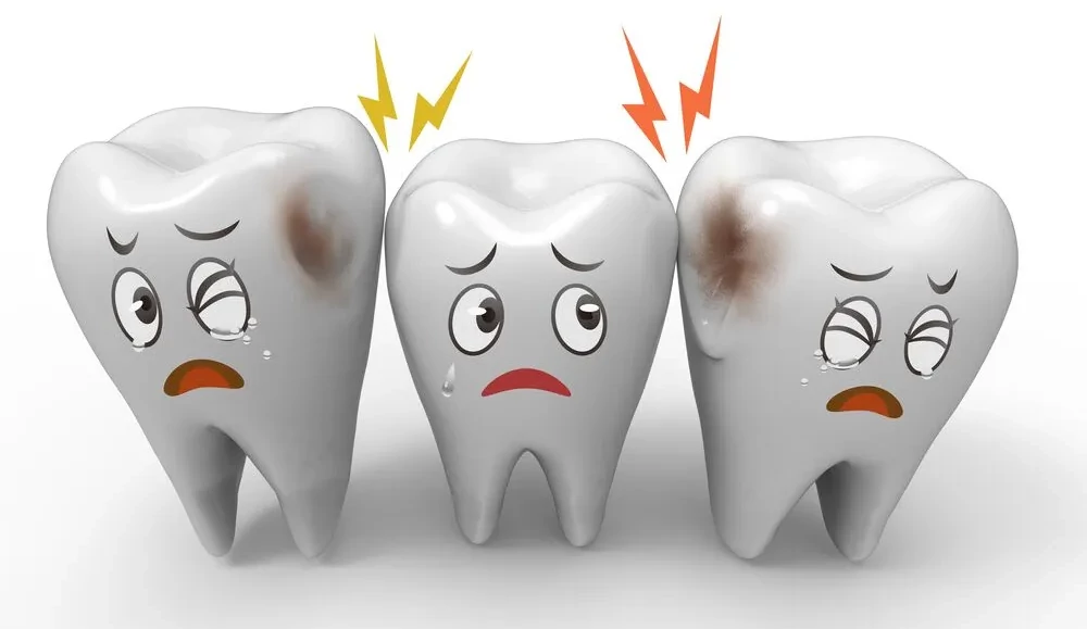 How Cavities Form: Enamel Erosion from Bacterial Plaque Close-up illustration of tooth enamel erosion caused by plaque and bacteria