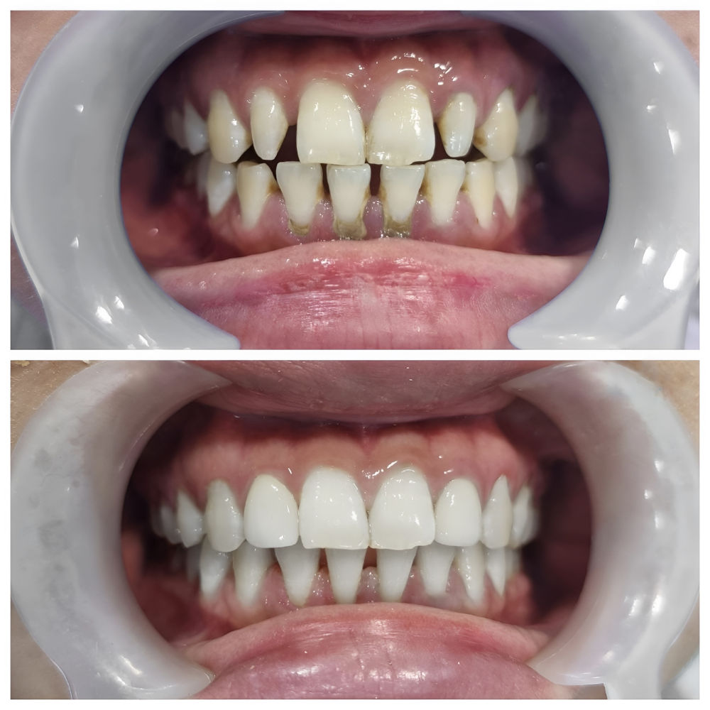 Before and After Results for Closing Tooth Gaps with Invisalign Before and after photo showing improvement of a large gap between teeth after orthodontic treatment