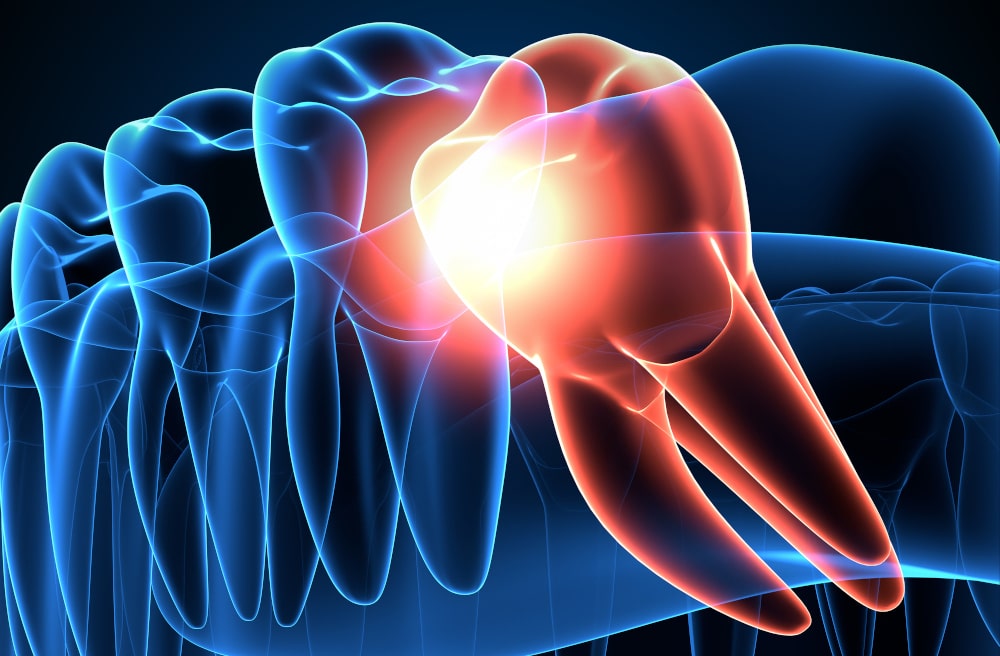 Dental panoramic X-ray highlighting a mesially impacted lower wisdom tooth
