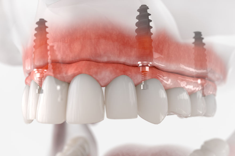 The Basics of Teeth in a Day Procedure Maxillary prosthesis image, showing the custom-made plate or bridge that mimics the appearance of a full set of teeth attached to dental implants.