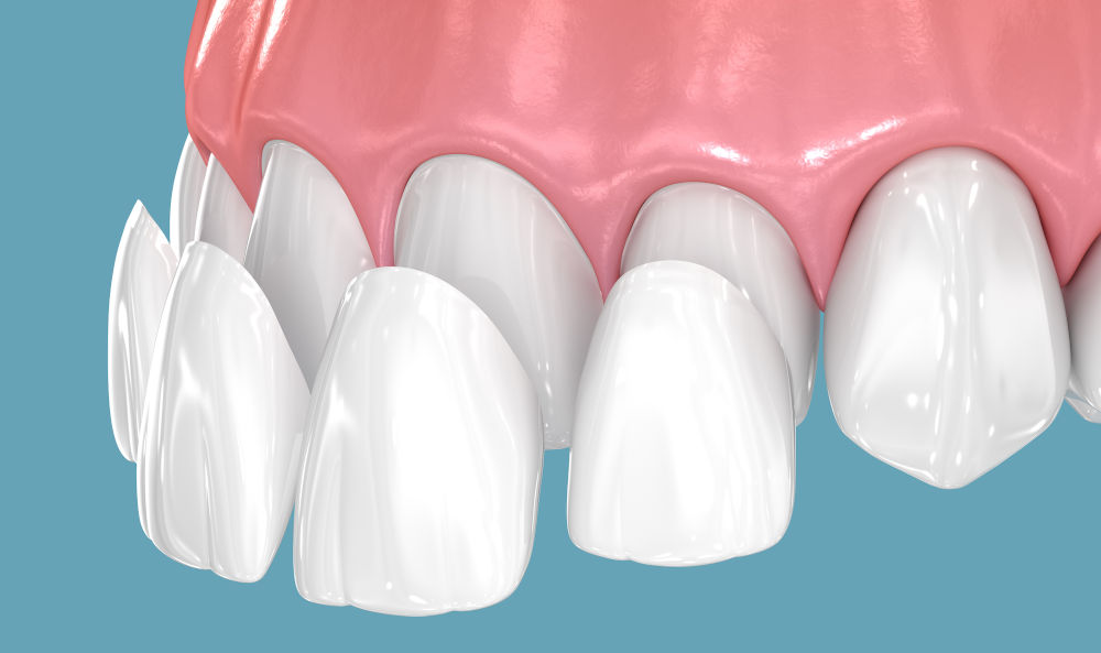 Porcelain Dental Veneers 3D Illustration 3D illustration of dental veneers showing thin shells used to improve tooth colour and shape