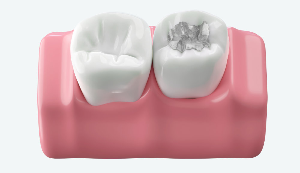 Close-up of white composite fillings &mdash; natural resin filling matching the colour of the tooth.
