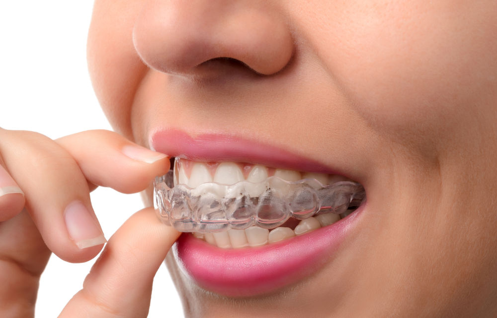 How Invisalign Works to Straighten Teeth Woman wearing an orthodontic silicone trainer, representing Invisalign aligners as a comfortable and discreet option for teeth straightening.